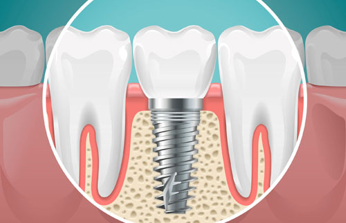 Dental Implants