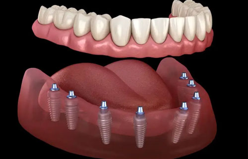 All on 6 / All on 8 Dental Implants
