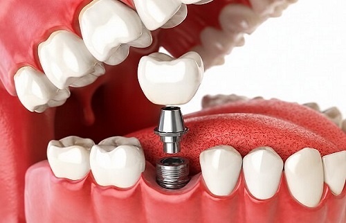 Best Dental Implant Clinic in Ghatkopar West