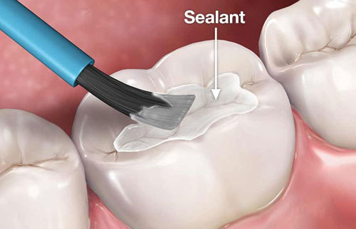 Pit & Fissure Sealants