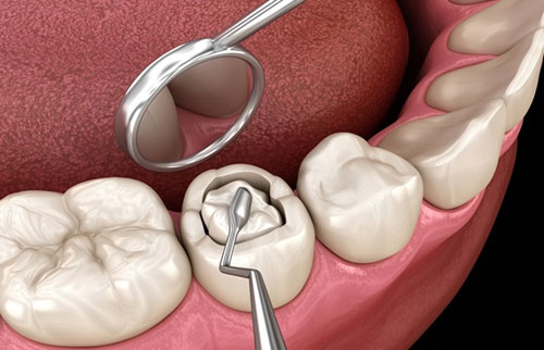Dental Fillings
