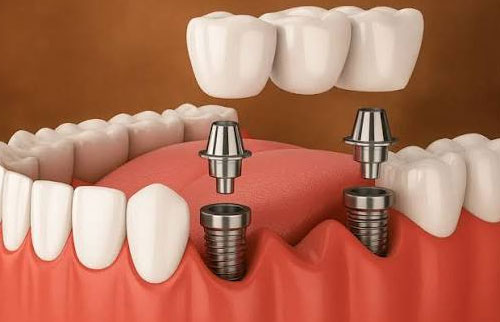 Dental Implants