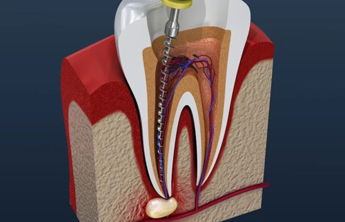 Root Canal Treatment
