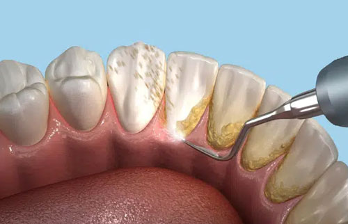 Teeth Cleaning