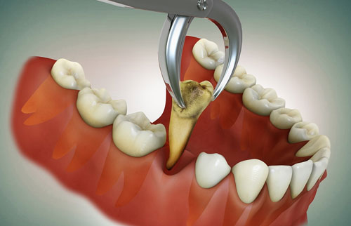 Extractions